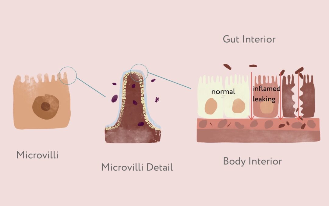 Leaky Gut Syndrome: What Happens When the Intestine is Leaky?